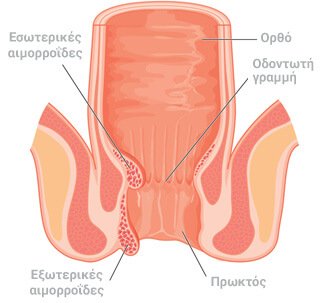 αιμορροΐδες