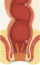 Φυσιολογική κατάσταση αιμορροΐδων