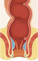 Αιμορροΐδες 1ου βαθμού