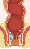 Αιμορροΐδες 2ου βαθμού