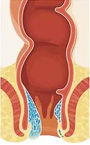 Αιμορροΐδες 3ου βαθμού