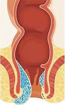 Αιμορροΐδες 4ου βαθμού