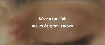 έρπης μάτι 1