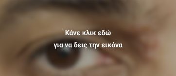 έρπης μάτι 2
