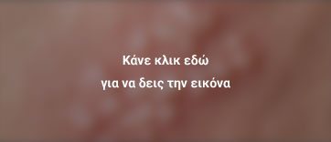 έρπης ζωστήρας 2