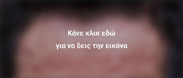 έρπης ζωστήρας 4