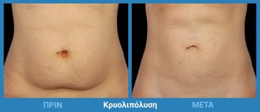 Κρυολιπόλυση Πριν Μετά 1