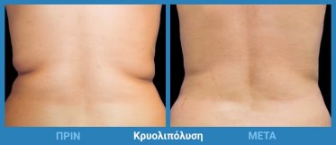 Κρυολιπόλυση Πριν Μετά 2