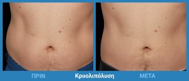 Κρυολιπόλυση Πριν Μετά 3