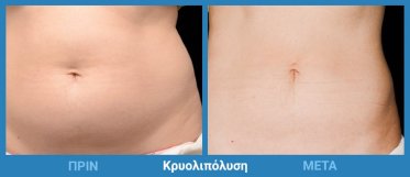 Κρυολιπόλυση Πριν Μετά 4