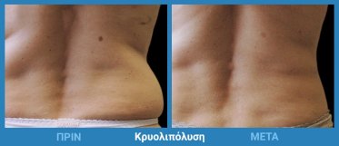 Κρυολιπόλυση Πριν Μετά 5