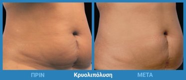 Κρυολιπόλυση Πριν Μετά 6