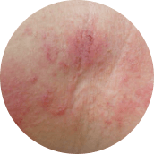 Κοκκίνισμα