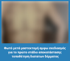 Πλαστική στήθους
