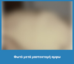 Πλαστική στήθους