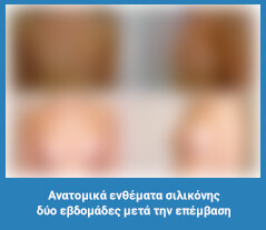 Πλαστική στήθους