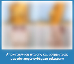 Πλαστική στήθους