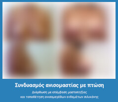 Πλαστική στήθους