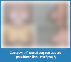 Πλαστική στήθους