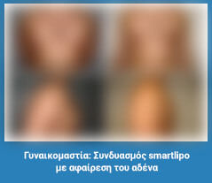 Πλαστική στήθους