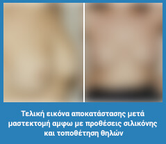 Πλαστική στήθους