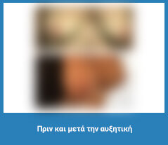 Πλαστική στήθους
