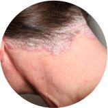 Αυτοάνοσα νοσήματα