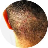 Φλεγμονή από μικρόβια και βακτήρια