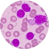 Νεοπλασίες δέρματος